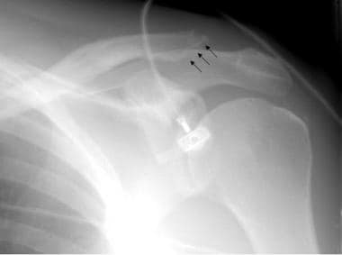 Radiograph of the shoulder in a patient with prima