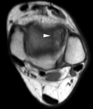 Axial T1-weighted image at the level of the ankle 
