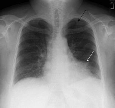 Semi-erect anteroposterior (AP) chest radiograph i