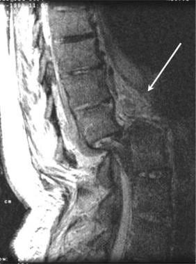 Thoracic spine trauma. Sagittal T2-weighted MRI of
