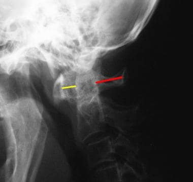 Lateral flexion view of the cervical spine shows a