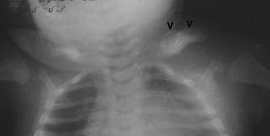 Frontal view of the chest shows diffuse cortical t