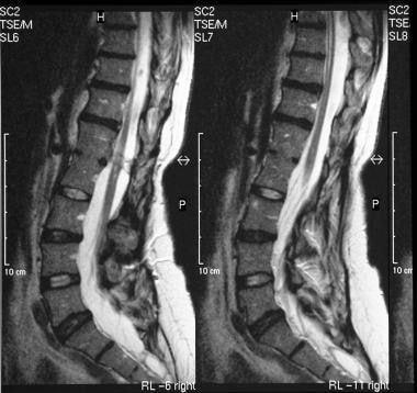 Sagittal MRIs of the lumbar spine show diastematom