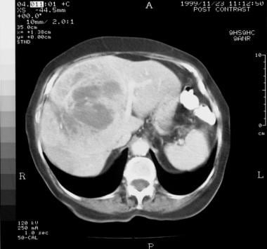 Contrast-enhanced axial CT scan through the liver 