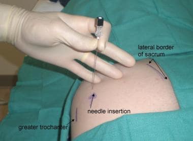 Fluoroscopy-guided piriformis injection. Greater t