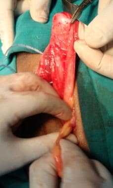 Open inguinal hernia repair. Lipoma of cord dissec