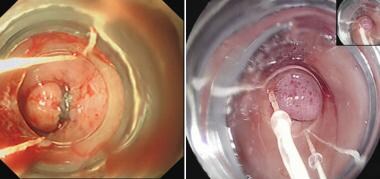 Endoscopic view of post-banding of the internal he