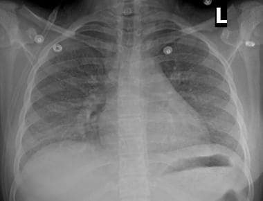 14-year-old girl with subacute hypersensitivity pn