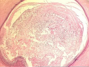 Epidermal Inclusion Cyst Histology