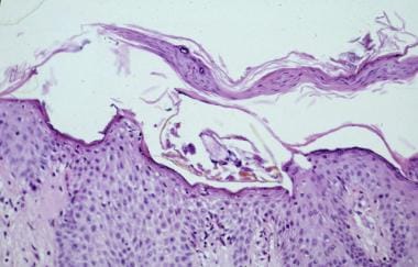 In routine scabies, a single mite is seen. Eosinop