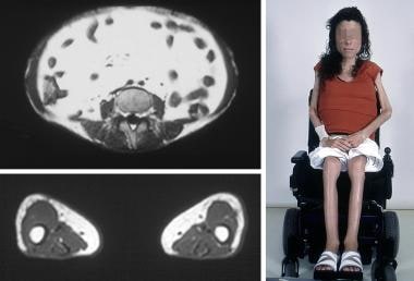 Congenital generalized lipoatrophy in a 16-year-ol