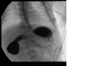 Pediatric duodenal atresia. Upper gastrointestinal