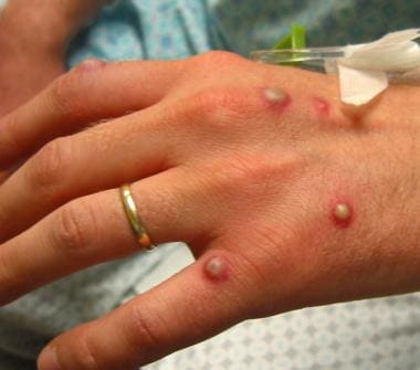 Vesicular rash on the dorsal aspect of the hand. V