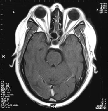 一个37岁的患者的大脑MRI