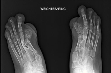 Radiograph of bilateral feet in the same patient a