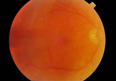 Fundus photograph of the same patient as in the im