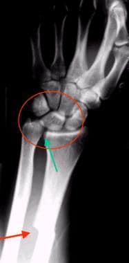 distal radioulnar joint x ray