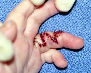 Hand of 26-month-old patient who underwent release