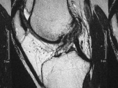 MRI is used as an aid to diagnose anterior cruciat