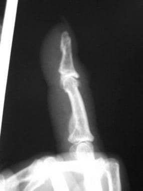 Dorsal osteophyte seen at the distal interphalange
