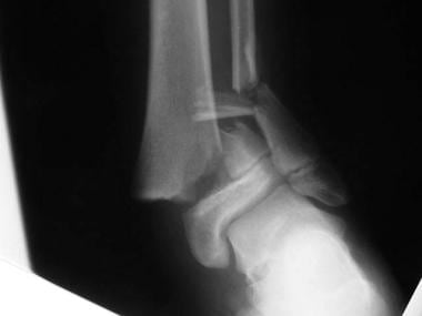 Growth plate (physeal) fractures. Anteroposterior 