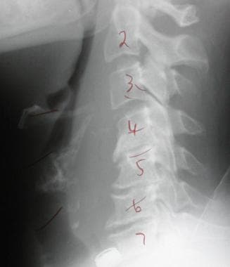 Spinal infections. Lateral plain radiographs of Pa