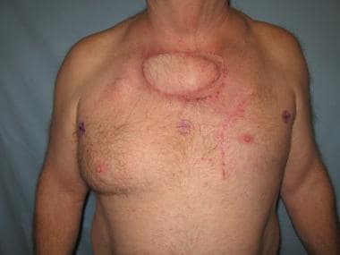 Chest wall reconstructed with pectoralis major myo
