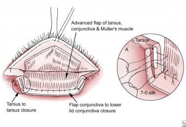 The flap is advanced and the upper tarsus sutured 