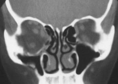 Coronal CT scan showing orbital floor fracture pos