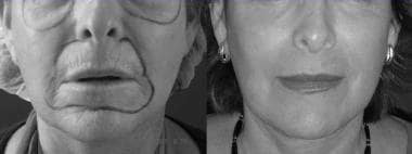 Erbium YAG Laser Skin Resurfacing: Practice Essentials, Problem,  Epidemiology