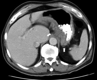 Inflammatory bowel disease. Computed tomography sc