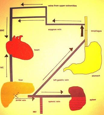 Redirection of flow through the left gastric vein 