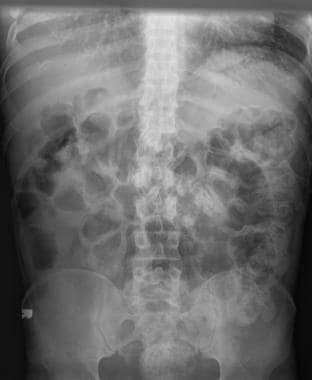 Fecal impaction, Radiology Reference Article