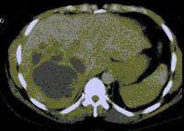 Computed tomography (CT) scan findings of liver ab