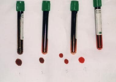 methemoglobinemia symptoms