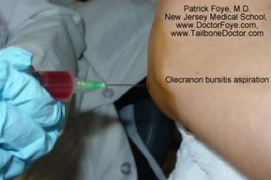 Olecranon bursitis: aspiration of hemorrhagic effu