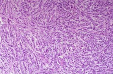 Gyriform pattern of adult granulosa cell tumor. Un