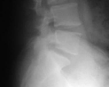 Radiograph of the lumbosacral junction showing a g