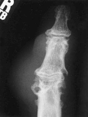 Gout. Radiograph of erosions with overhanging edge