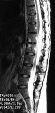 Sagittal MRI of thoracolumbar spine of a patient w