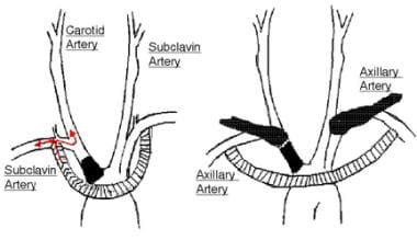 Subclavian-subclavian or axillary-axillary bypass 