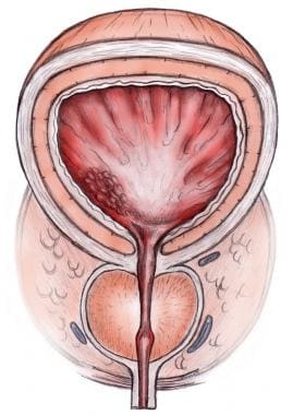 Prostate Hyperplasia 1 Art