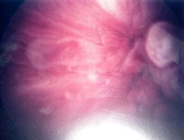 An endoscopic view of colovesical fistula (upper r