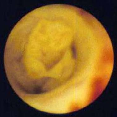 Ureteroscopic image of a papillary transitional ce