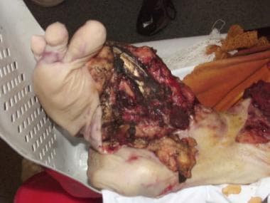 Crushed and mangled foot of a person who was invol