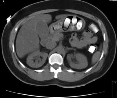 CT scan of patient transporting cocaine packets. 