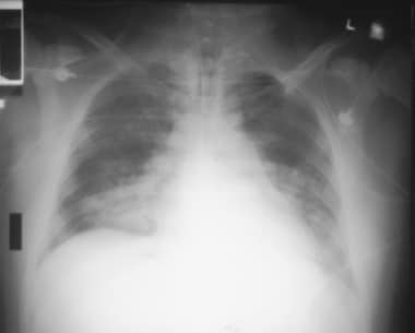 Anteroposterior portable chest radiograph in a mal