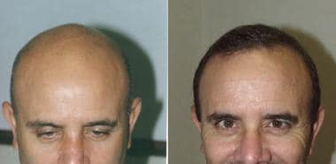 Transgender Hair Transplant Before and After Photos - Foundation For Hair  Restoration