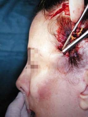 When an endoscopic forehead lift is done in conjun