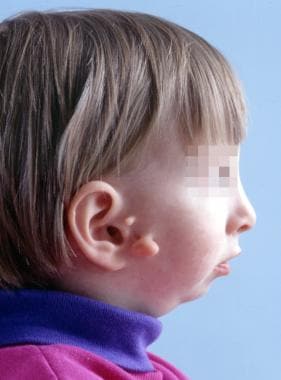 Multiple tags in a child with oculoauriculovertebr
